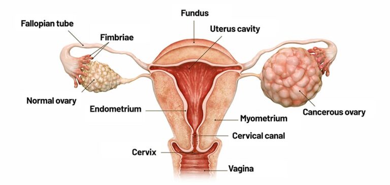 Ovarian Cancer
