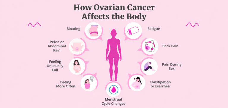 ovarian cancer