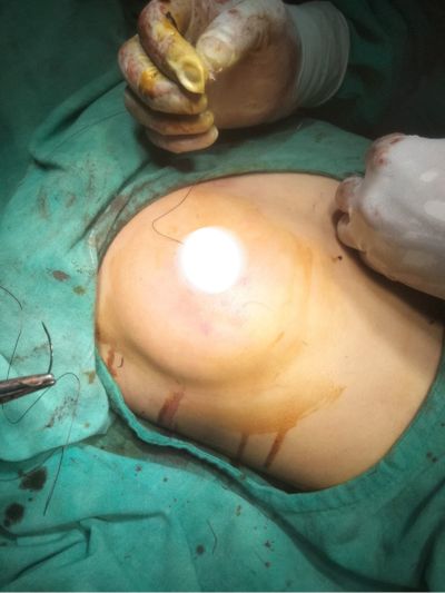 Breast Scarless Surgery